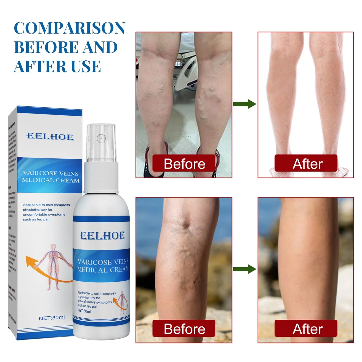 Eelhoe Varicose Veins Spray Massage Varicose Relieves Veins Earthworm Legs Spray to Relieve Leg Pain Blood Vessel Bulging Cream