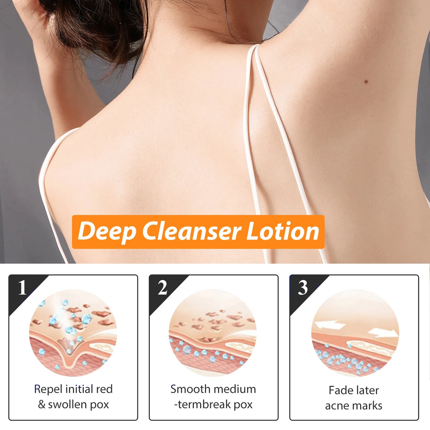 Anti Acne Body Lotion Back Butt Pimple Removal Moisturizing Whitening Joint Dark Melanin Brightening Spots Acne Treatment Lotion