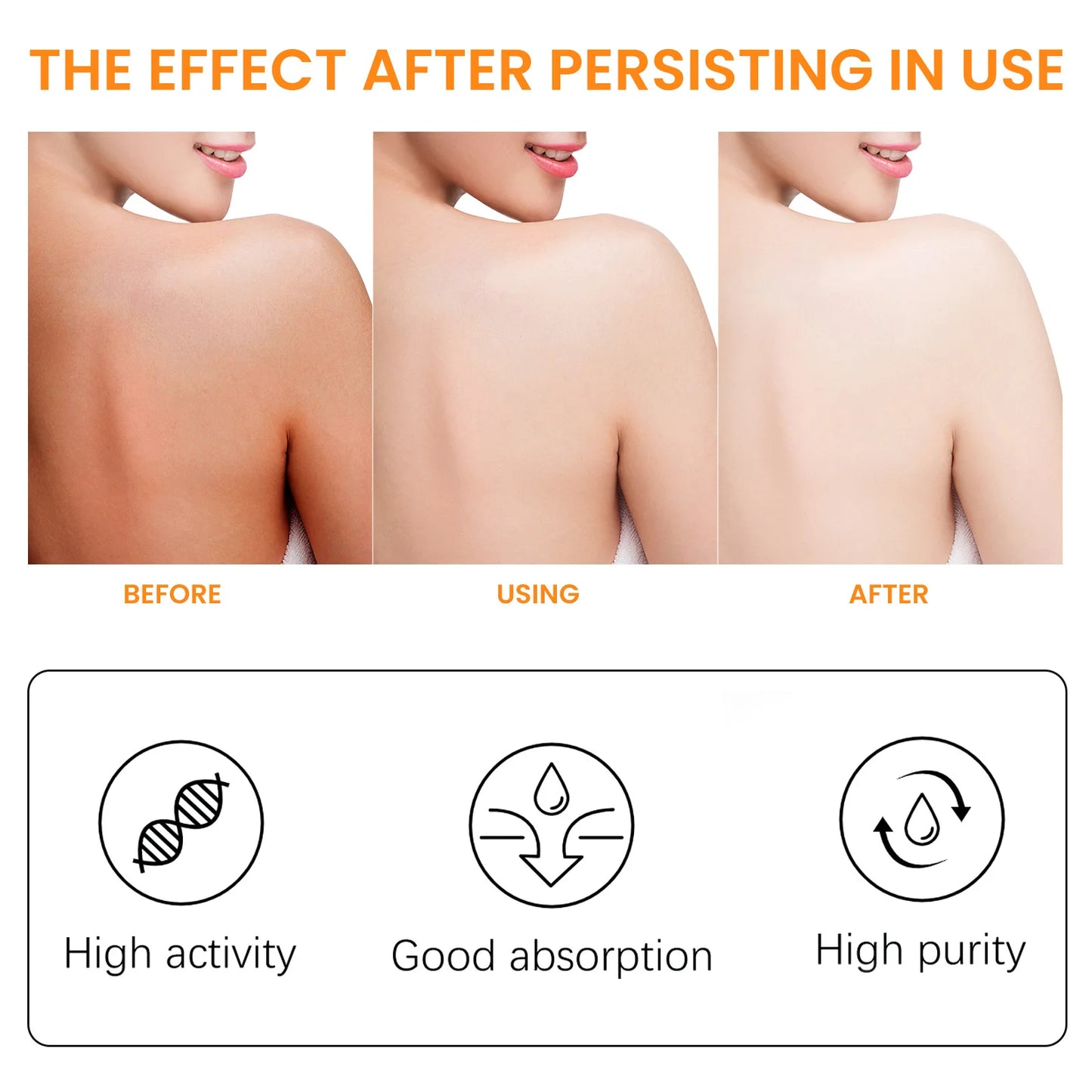 Anti Acne Body Lotion Back Butt Pimple Removal Moisturizing Whitening Joint Dark Melanin Brightening Spots Acne Treatment Lotion