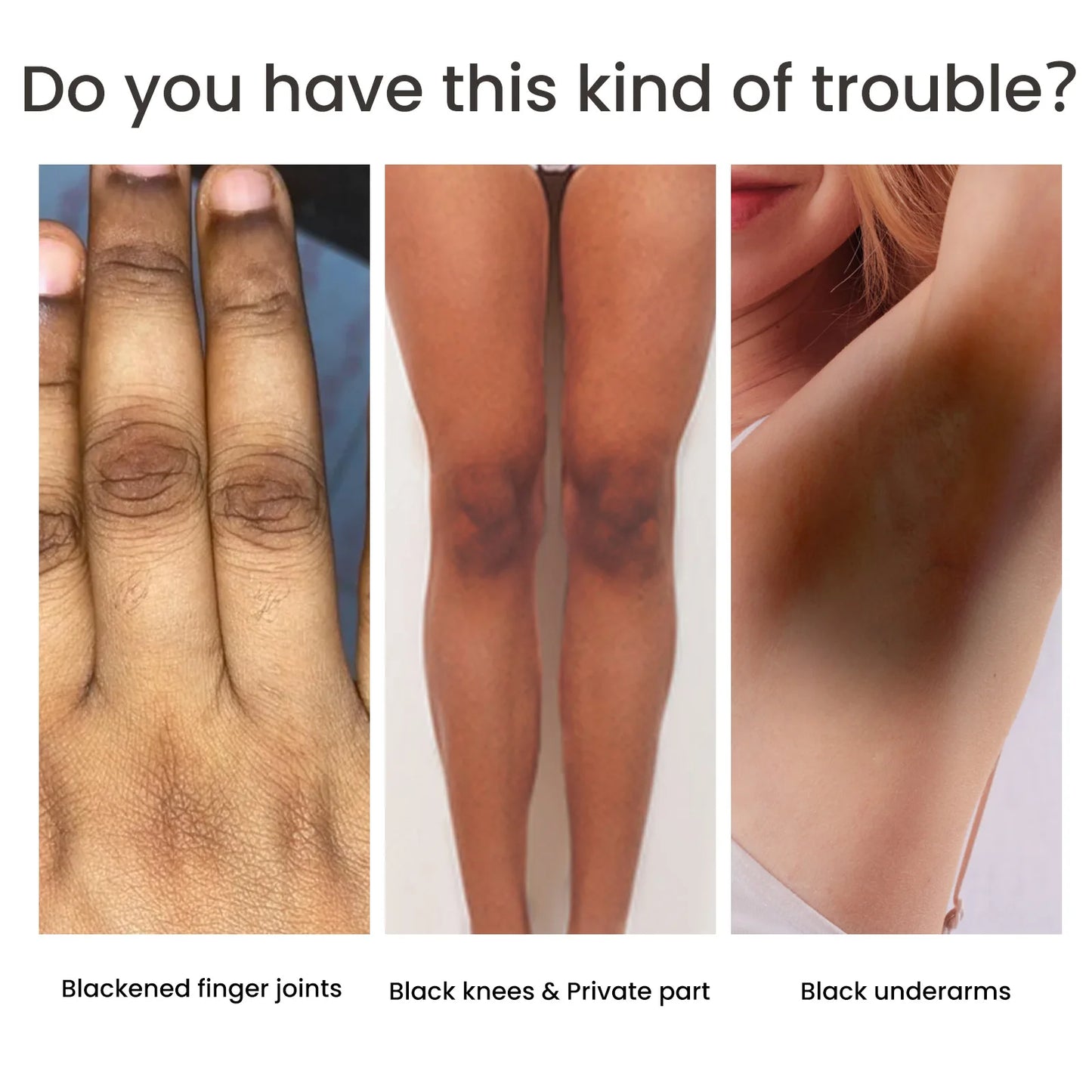 Private Parts Armpit Whitening Essence Nipple Bleach Remove Melanin Dark Knuckle Butt Knee Brighten Inner Thigh Lightening Serum