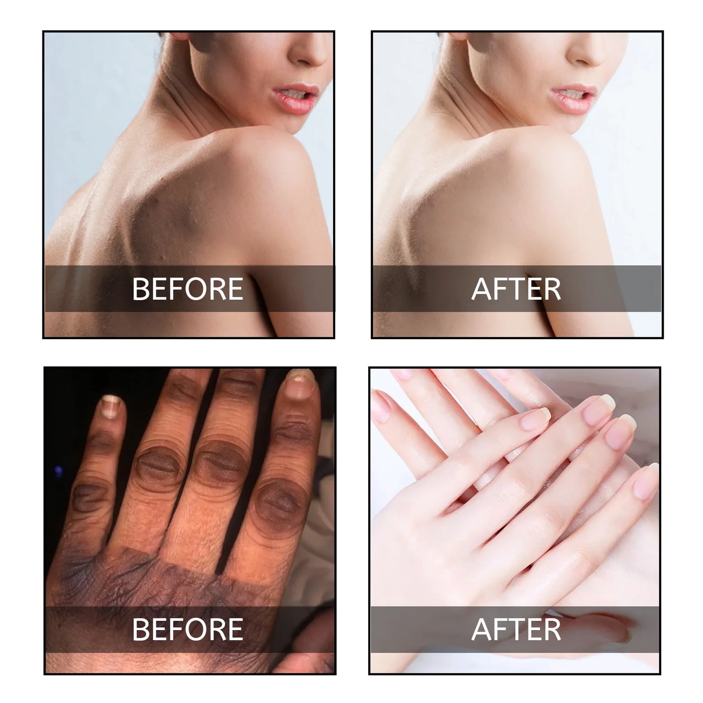 Anti Acne Body Lotion Back Butt Pimple Removal Moisturizing Whitening Joint Dark Melanin Brightening Spots Acne Treatment Lotion
