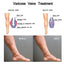 Eelhoe Varicose Veins Spray Massage Varicose Relieves Veins Earthworm Legs Spray to Relieve Leg Pain Blood Vessel Bulging Cream