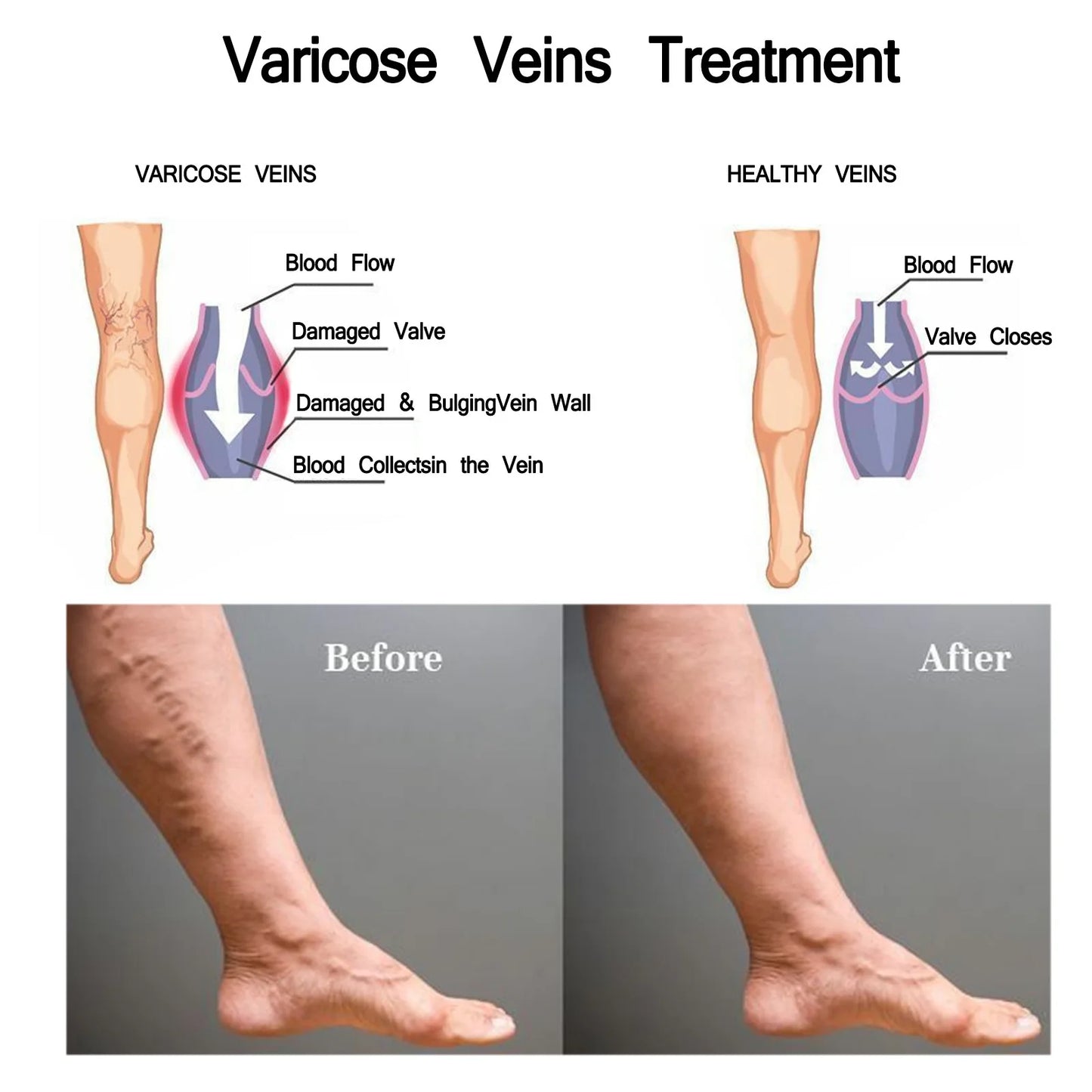 Eelhoe Varicose Veins Spray Massage Varicose Relieves Veins Earthworm Legs Spray to Relieve Leg Pain Blood Vessel Bulging Cream