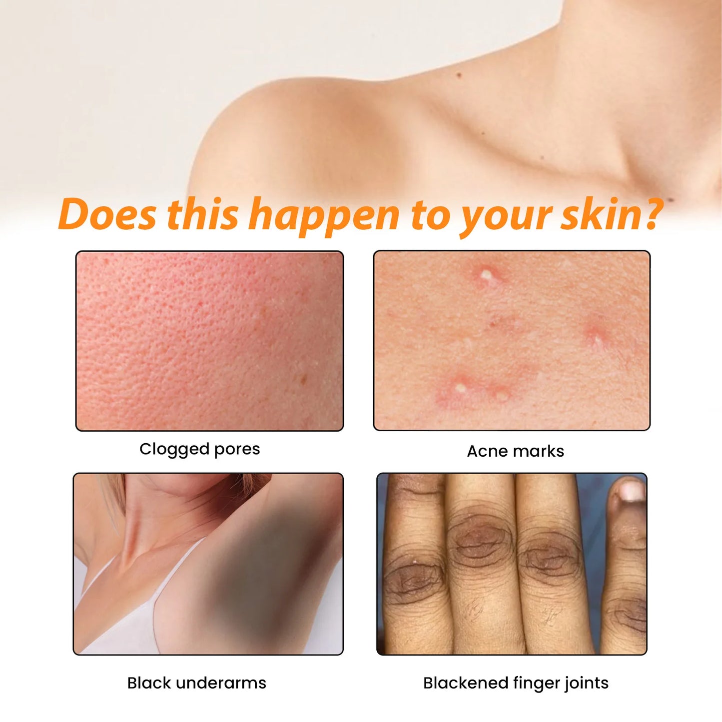 Anti Acne Body Lotion Back Butt Pimple Removal Moisturizing Whitening Joint Dark Melanin Brightening Spots Acne Treatment Lotion