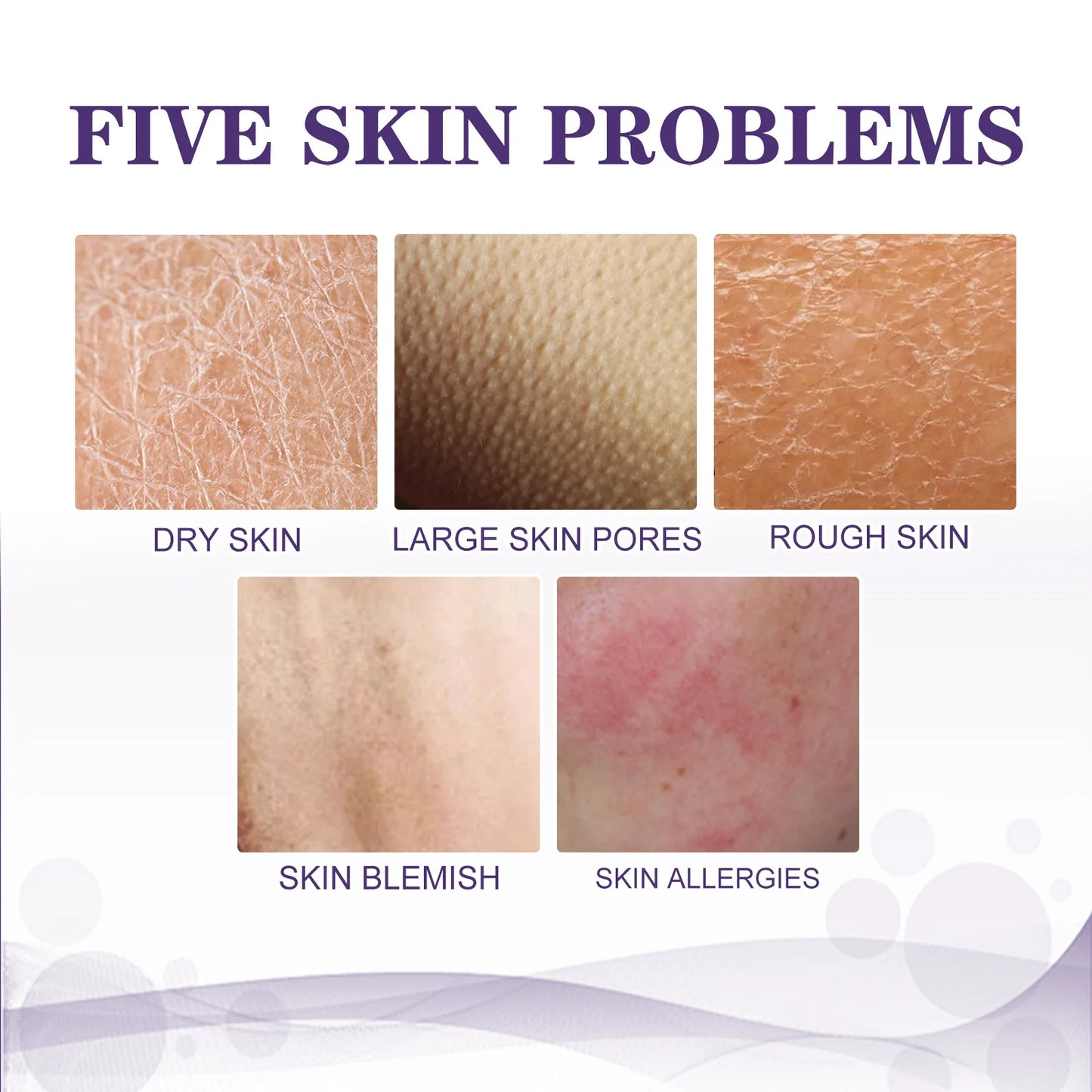 EELHOE Chicken Skin Repair Cream Curing Keratosis Pilaris Skin Treatment Body Lotion Deep Moisturizing Softening Whitening Cream
