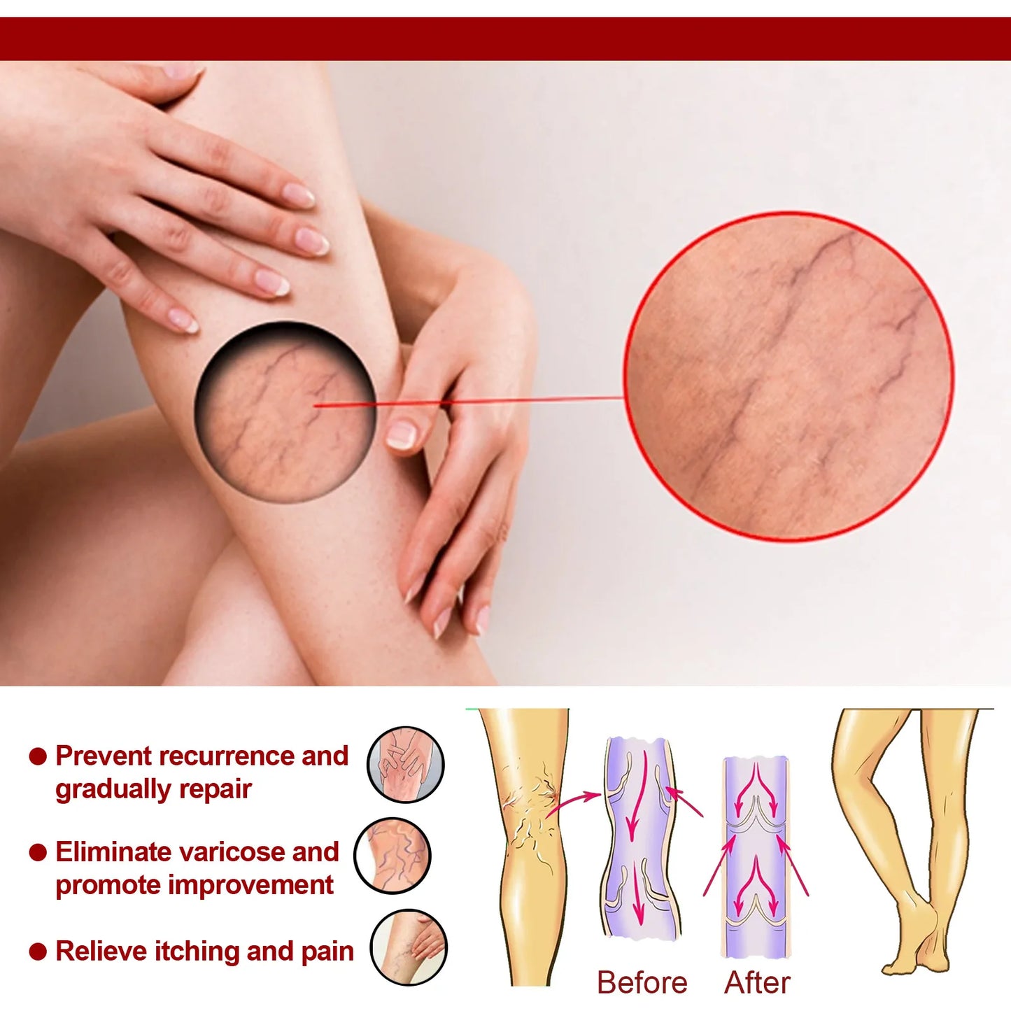 EELHOE Varicose Vein Massage Cream Relieves Leg Blood Vessel Bulging Calf Swelling Earthworm Leg Spider Inflammation Treat Cream