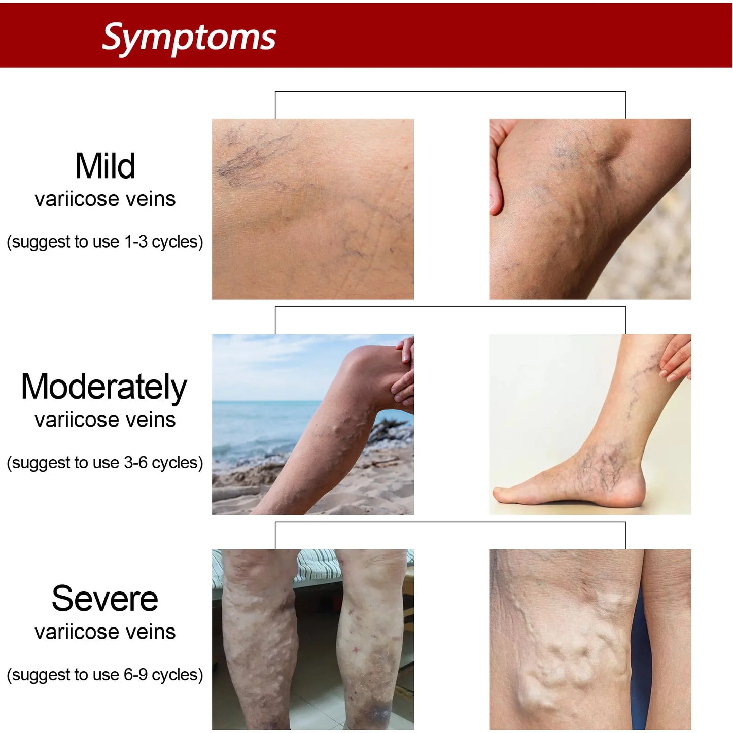 EELHOE Varicose Vein Massage Cream Relieves Leg Blood Vessel Bulging Calf Swelling Earthworm Leg Spider Inflammation Treat Cream